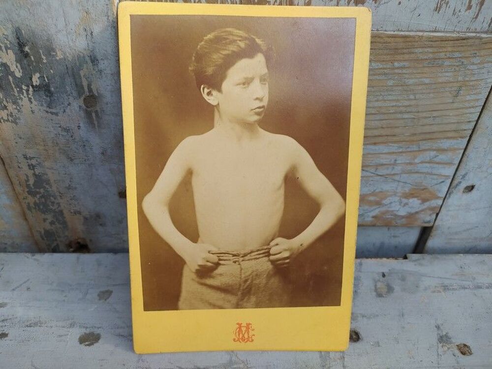 Photographies M&eacute;dicales XIX&egrave;me Enfant par Mass&eacute;rini &agrave; Lyon 