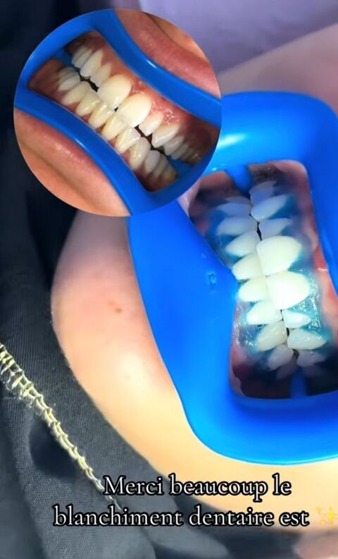 Blanchiment dentaire 0 95100 Argenteuil