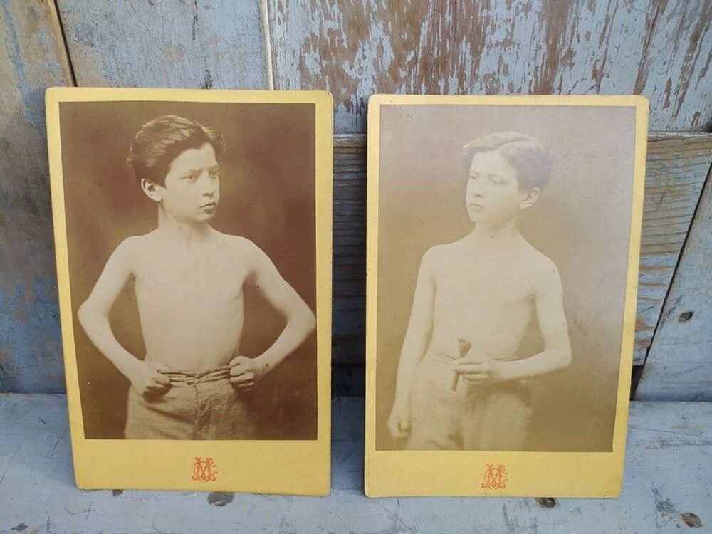 Photographies M&eacute;dicales XIX&egrave;me Enfant par Mass&eacute;rini &agrave; Lyon 